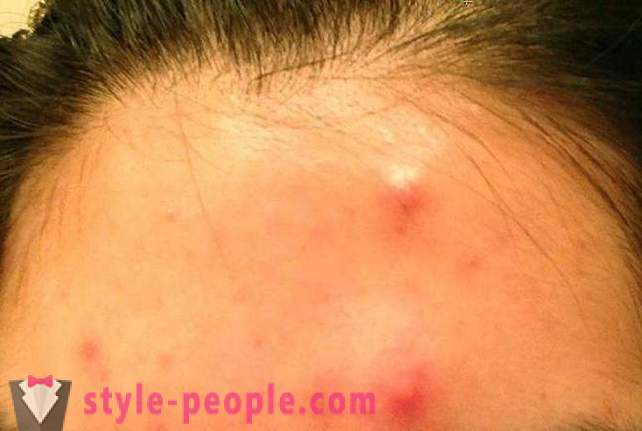 En cuanto a la noche para deshacerse del acné en casa?