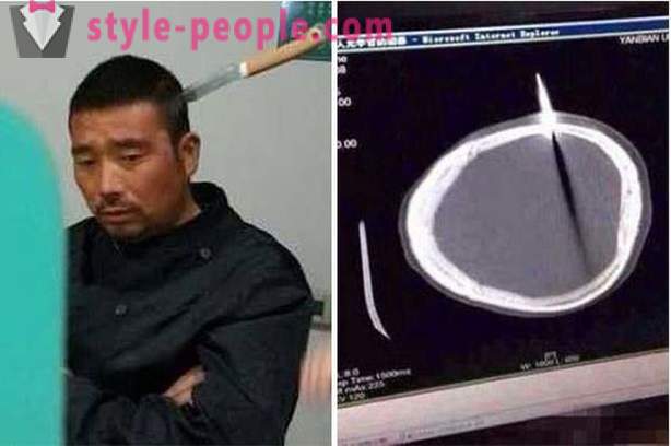 Un hombre chino con un cuchillo en la cabeza que fue al médico