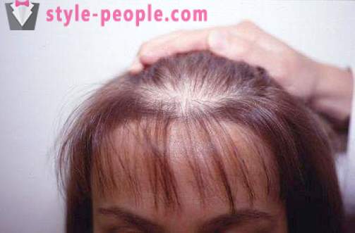 Darsonval pelo. darsonvalya aplicación para el tratamiento y la prevención de la caída del cabello