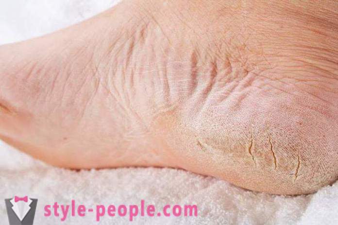 La piel seca en los pies: Causas