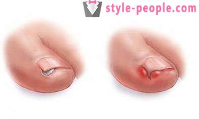 Uña encarnada en el dedo gordo del pie: causas y tratamiento