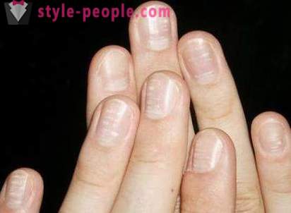¿Qué significan las manchas blancas en las uñas